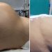 पेट में 10.6 किलो का ट्यूमर देख हैरान रह गए डॉक्टर, 6 घंटे की सर्जरी के बाद किया सफलतापूर्वक बाहर