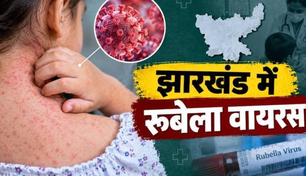 झारखंड में रूबेला का पहला मामला, 10 साल की बच्ची संक्रमित; जानें लक्षण और बचाव